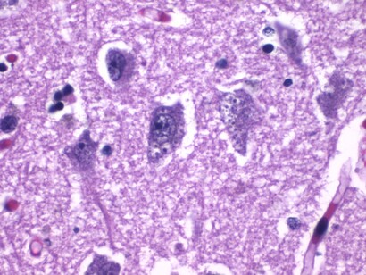 Histopatología de la degeneración granulovacuolar en la enfermedad de Alzheimer. Tinción con hematoxilina y eosina. 11 de agosto de 2020