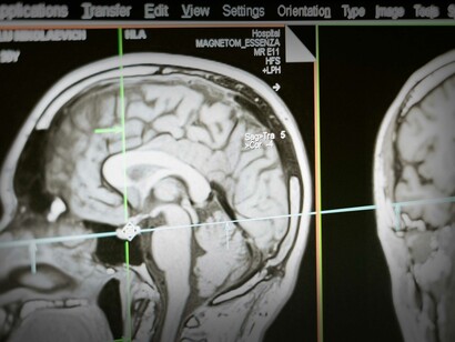 Il Sistema Nervoso Centrale, intracranico, è suddiviso principalmente in due emisferi: destro e sinistro