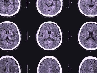 Se está observando la presencia de ictus en adultos jóvenes sin factores de riesgo cardiovascular que sufren COVID-19