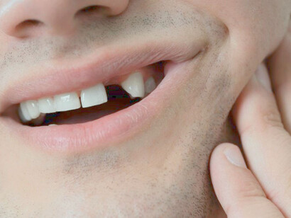 A man smiling, suffering from hypodontia