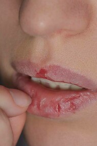 A person picking at their lips compulsively is a sign of dermatillomania