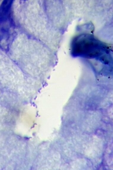 Helicobacter pylori en un caso de gastritis