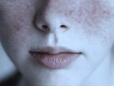 Lupus