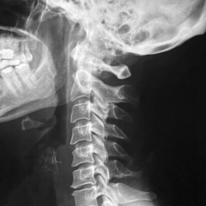Radiografía de latigazo cervical