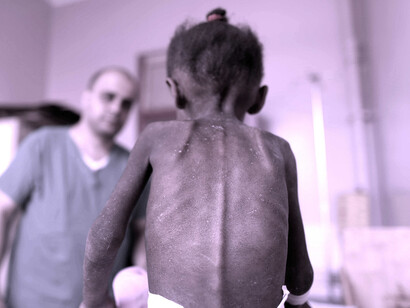Una niña desnutrida en un hospital yemení