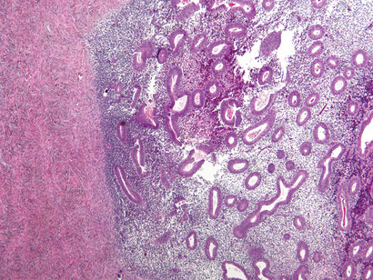 La ecografía es otra prueba común para detectar la endometriosis; puede realizarse a través de la pelvis o la vagina. Micrografía de endometriosis del ovario