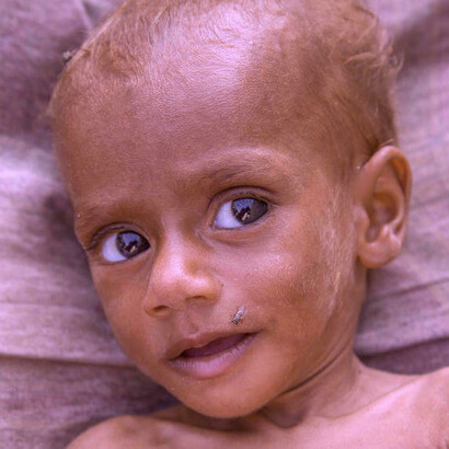 Cada diez minutos muere un niño en Yemen