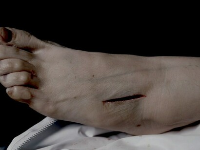 Andres Serrano | The Morgue (Rat Poison Suicide II) (Infectious Pneumonia), 1992