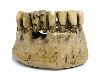 Protesi di età romana