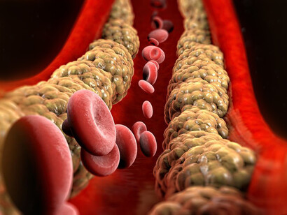 Sezione di arteria colpita da colesterolo