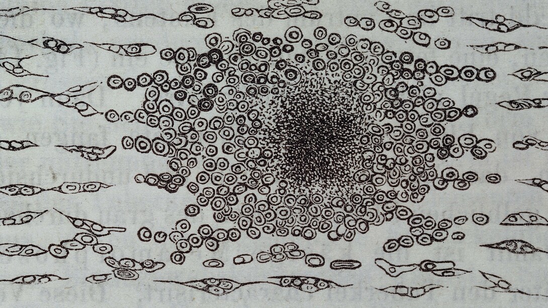 Figura 140 de la primera edición en alemán de la principal obra de Virchow:  «Die Cellularpathologie» («Patología celular»)