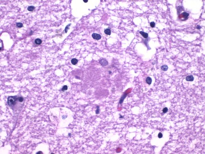 Histopatología de las placas amiloides en el hipocampo en la enfermedad de Alzheimer. Tinción con hematoxilina y eosina. 11 de agosto de 2020
