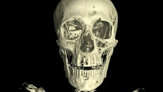 Linenman skull. The CT scan of the skull of the mummy of an adult man (name unknown). The scan shows considerable evidence of dental abbcesses and the loss of several teeth. © Trustees of the British Museum