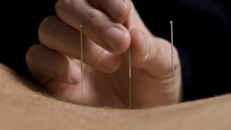 Acupuntura, la rama más conocida de la MTC