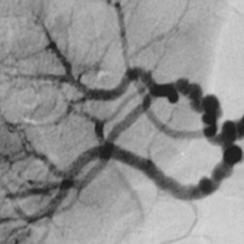 Angiografía de un aneurisma cerebral