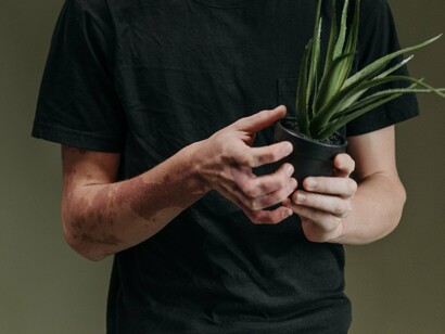 A person with skin condition holding a healthy aloe vera plant, symbolizing the natural healing power of easy-to-grow houseplants
