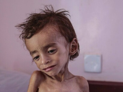 La malnutrición es la causa de casi la mitad de las muertes de niños y niñas menores de cinco años