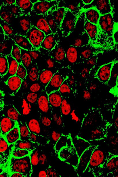 Las células de cáncer de colon humano con los núcleos celulares teñidos de rojo y la proteína E-cadherina teñida de verde