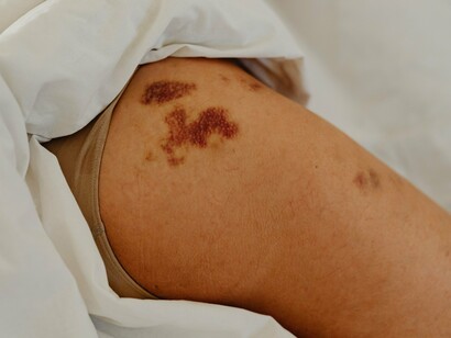 Marcas de cor marrom aparecem na pele de uma perna parcialmente coberta por lençóis. Embora alterações na pele possam chamar a atenção, sua aparência isolada não permite determinar a causa. A avaliação dermatológica é importante para distinguir diferentes condições cutâneas e investigar possíveis sinais de melanoma