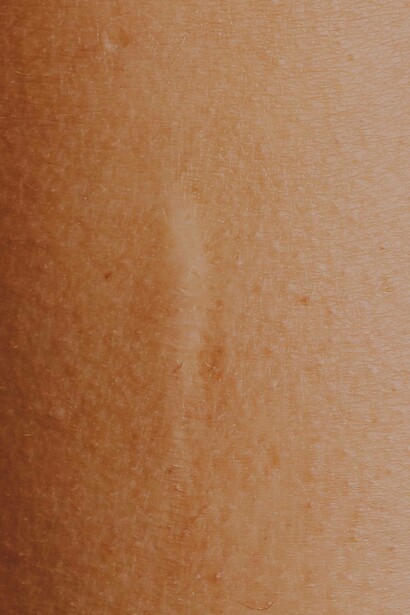 Faded scar on skin