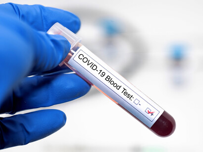 Según el estudio actual, la enfermedad COVID-19, causada por el coronavirus SARS-CoV-2, comprende al menos cinco variantes