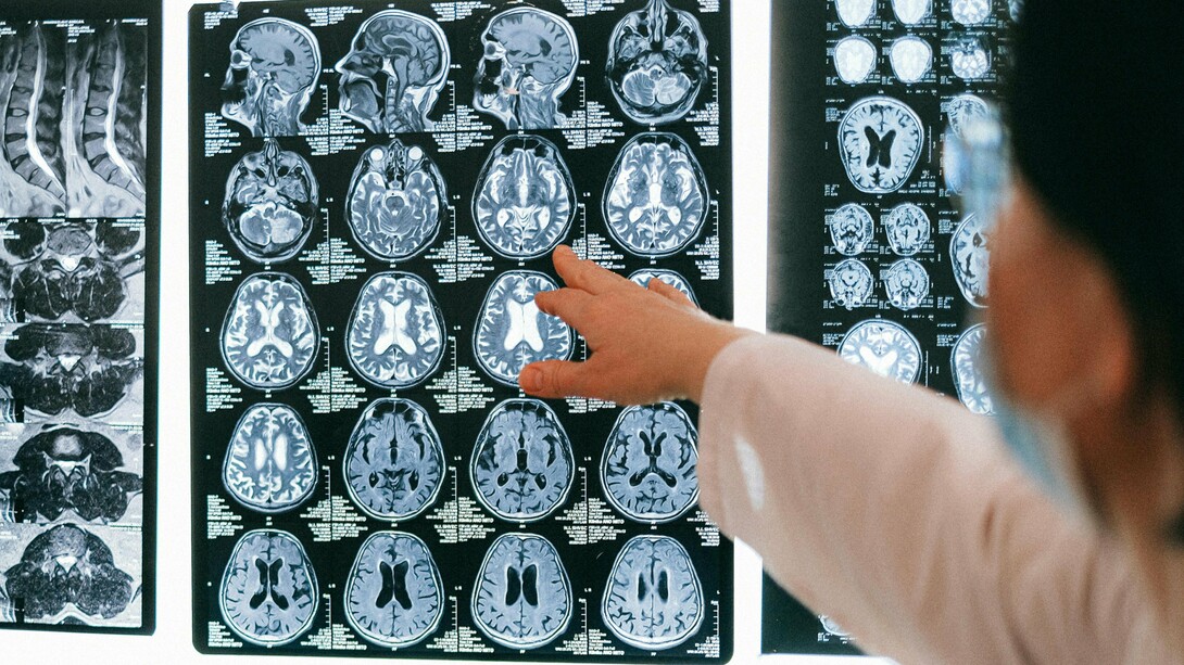 A Síndrome de Stiff-Person, também conhecida como Síndrome da Pessoa Rígida, é uma doença neurológica rara, crónica e potencialmente incapacitante. Ainda assim, permanece pouco conhecida fora dos círculos especializados. O resultado é previsível: anos de consultas, exames inconclusivos, diagnósticos fragmentados e uma sensação recorrente de não reconhecimento por parte de quem procura ajuda
