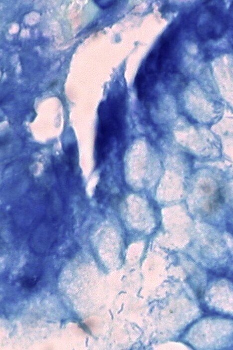 Helicobacter pylori en una biopsia estomacal