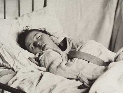 Female patient with sleep hysteria