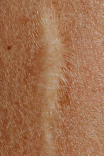 Scar post surgery