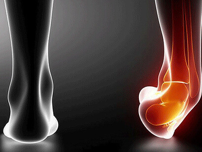 La cosiddetta "storta" alla caviglia