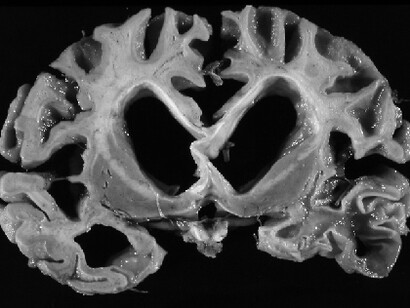 El sistema nervioso central (SNC) es vulnerable a los virus