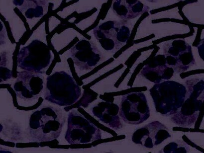 «Bacillus anthracis» en líquido cefalorraquídeo