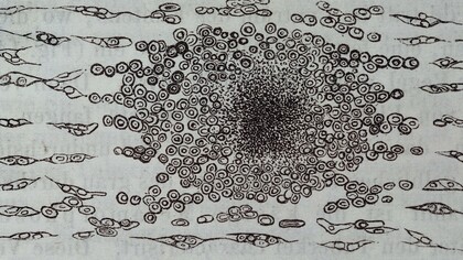 Figura 140 de la primera edición en alemán de la principal obra de Virchow:  «Die Cellularpathologie» («Patología celular»)