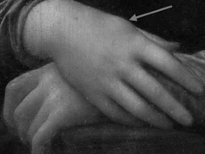 Xanthelasma and arthrogenic ganglion