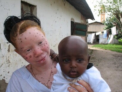 Albinos en África