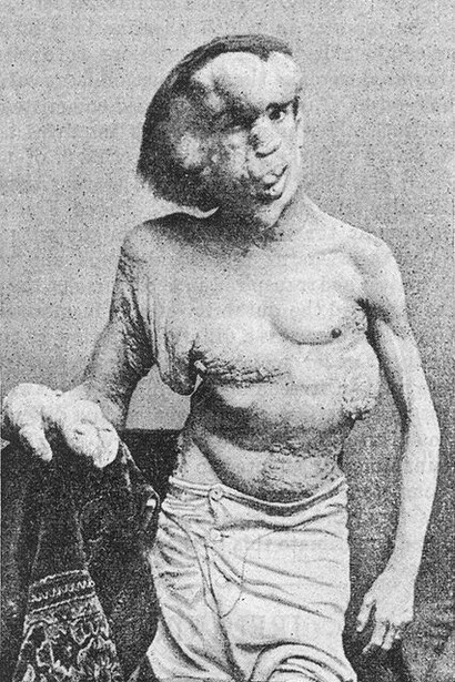 Joseph Merrick (1862-1890), El Hombre Elefante