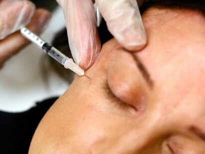 Violencia estética. Inyección de toxina botulinica