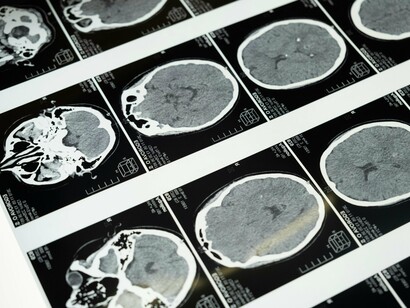 Lembre-se, cada caso é único, e o manejo dessas condições deve ser individualizado com base nas necessidades específicas de cada paciente. A pesquisa contínua nessas áreas promete trazer novos insights e opções de tratamento no futuro, oferecendo esperança para aqueles afetados por essas condições