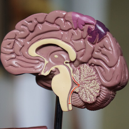Cervello. la demenza è caratterizzata da un declino di molteplici funzioni cognitive, memoria (a breve e a lungo termine) e almeno una tra pensiero astratto, capacità critica, linguaggio, orientamento spazio-temporale