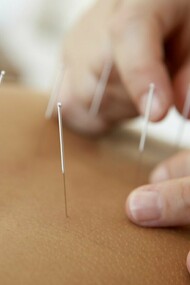 Acupuncture