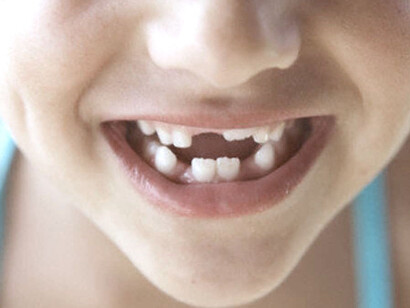 A little boy smiling, suffering from hypodontia