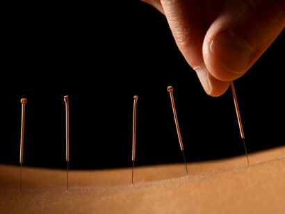 Acupuncture and acupoints