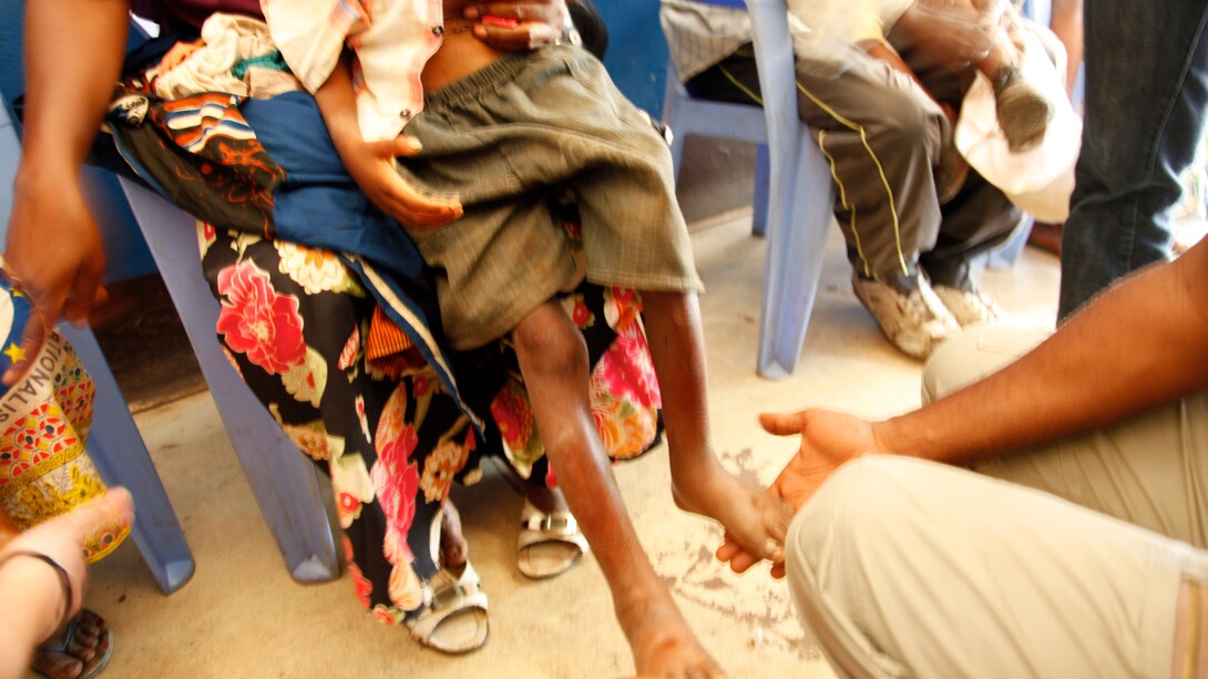 La ayuda del Reino Unido ha ayudado a "Acción contra el Hambre" a reducir los niveles de desnutrición en el distrito de Masi Manimba, donde muchas familias siguen siendo vulnerables y tienen dificultades para costear o acceder a una dieta básica saludable.Un niño es examinado para detectar signos de desnutrición en el hospital general local de Masi Manimba, República Democrática del Congo