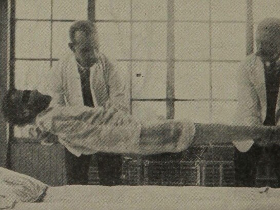 Un caso straordinario di rigidità catatonica. Sostenuto solo dalle spalle e dai piedi, il corpo è completamente sospeso a mezz'aria, 1915