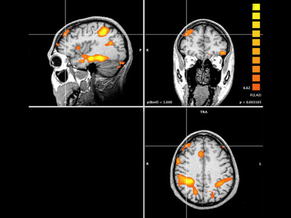 Respuesta de la amígdala y el córtex prefrontal frente a estímulos negativos