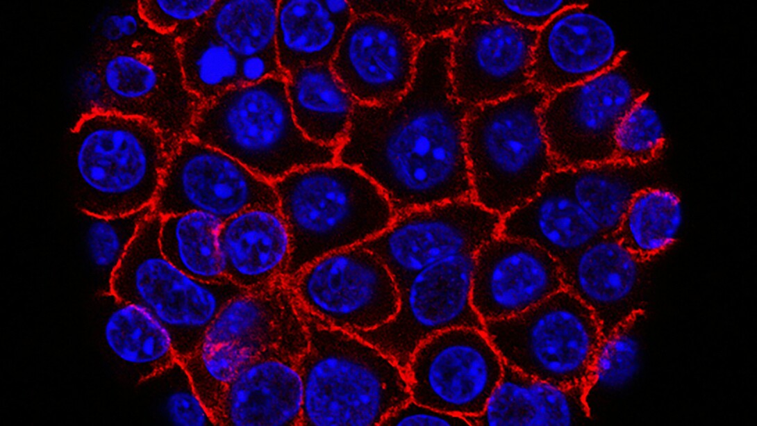 New hope for pancreatic cancer: researchers identify CAPG, a promising biomarker that could transform early detection and future treatment strategies