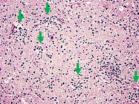 Histopatología de la poliomielitis paralizante