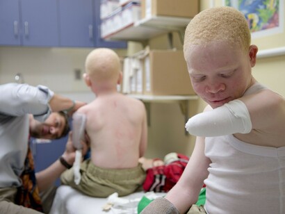 Niño albino con una mano amputada