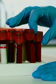 Medicina preditiva é o campo da saúde que busca antever doenças antes que se desenvolvam, usando marcadores biológicos, ambientais, epigenéticos e genéticos. Seu objetivo não é apenas diagnosticar precocemente, mas principalmente estimar o risco individual de desenvolver certas condições ao longo da vida. Trata-se de um modelo que antecipa, em vez de apenas reagir. Nesse contexto, os testes genéticos despontam como uma das ferramentas mais promissoras. Eles analisam sequências específicas do DNA em busca de variantes associadas a doenças hereditárias, como câncer de mama, Alzheimer, doenças cardiovasculares, diabetes tipo 2, entre outras