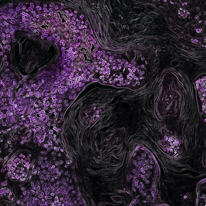 Anticancer drug. There are many types of immunotherapy that are used to treat and possibly cure some types of cancer